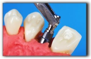 Dental implant procedure