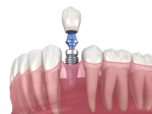 Digital model showing parts of dental implant