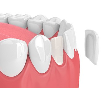 Illustration of veneer being placed on front tooth