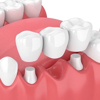a digital illustration of a traditional dental bridge