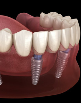 Digital illustration of an All-On-4 dental implant denture in Orange