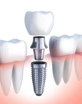 Digital illustration showing the different parts of a dental implant in Orange