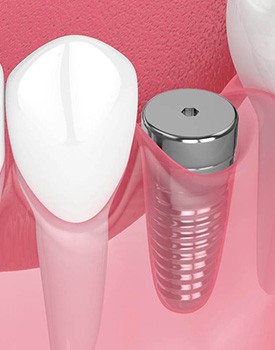 Digital illustration of a dental implant