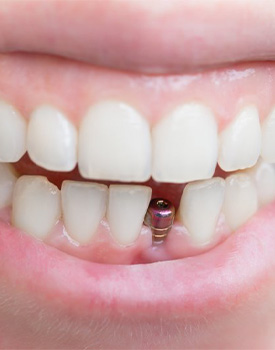 Smile with dental implant