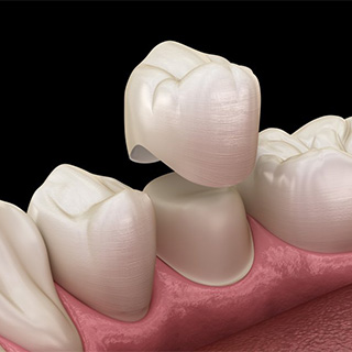 Exploded illustration of tooth and dental crown.