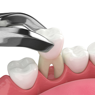 Illustration of a tooth extraction.