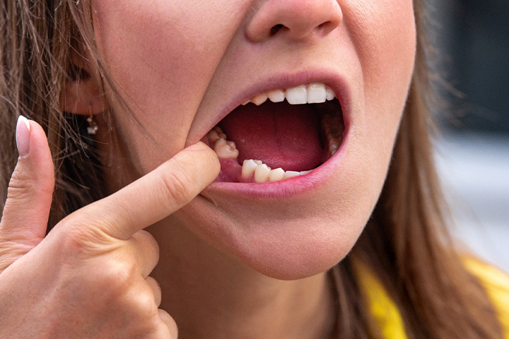 Woman missing a tooth.